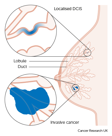 Ce este cancerul mamar invaziv (NST)?